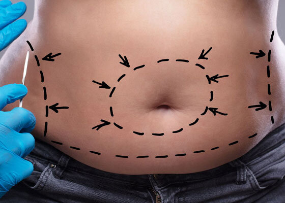 Tummy Tuck