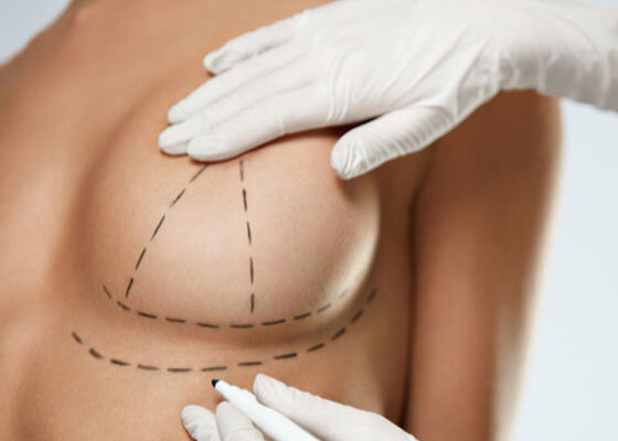 Breast Lift
